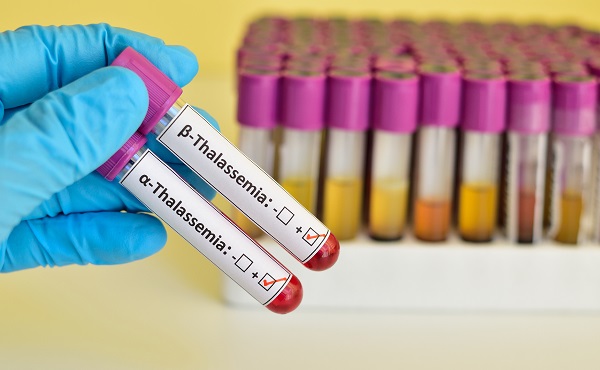 Beta and alpha thalassemia blood sample