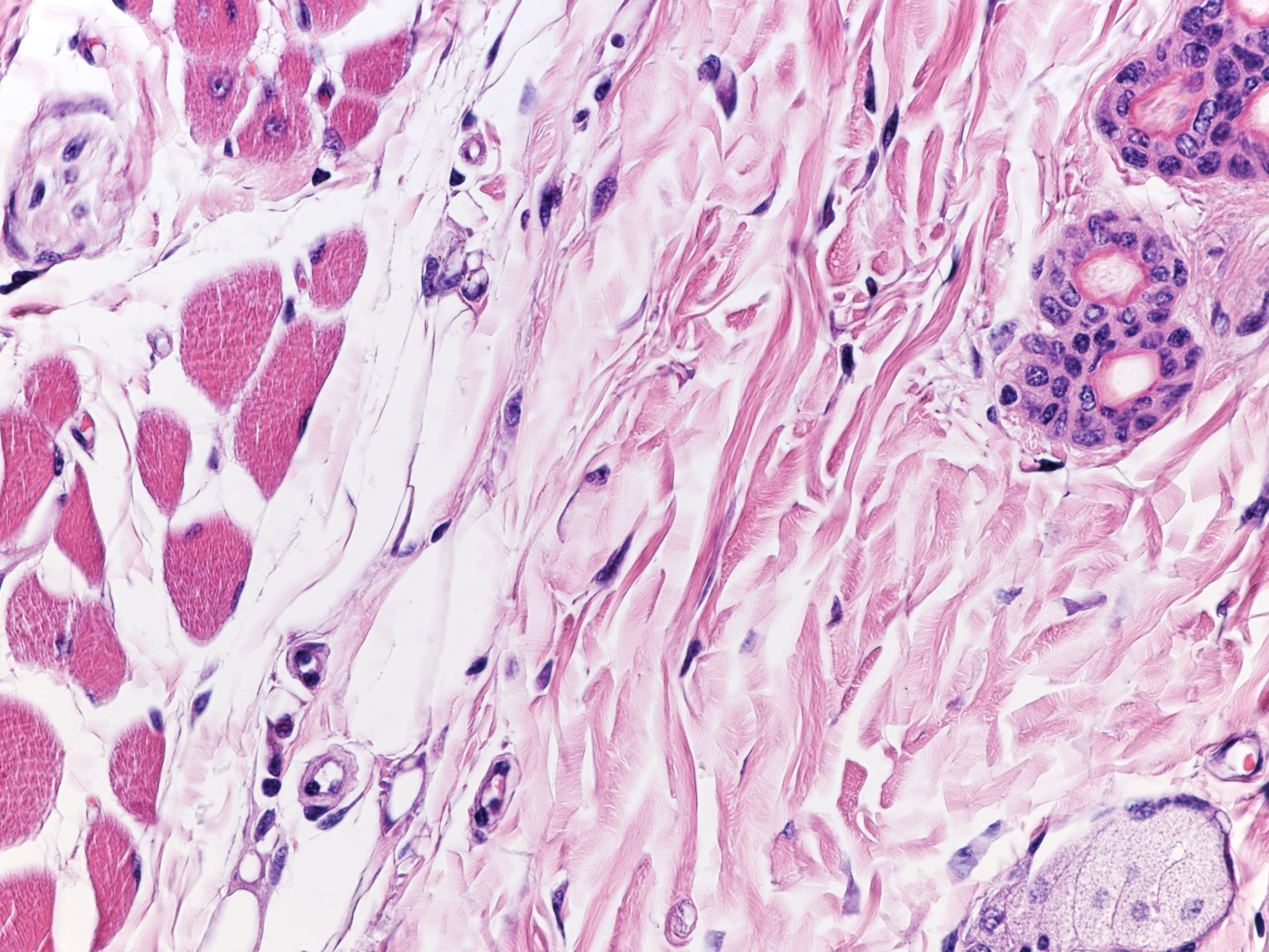 Syndrome de CLOVES et autres syndromes d’hypercroissance pathologiques
